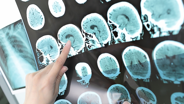 A person points to a brain scan