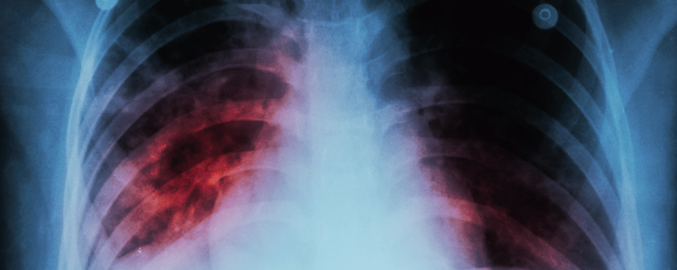 A photo of a chest xray