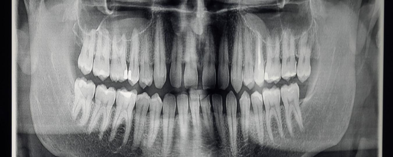 X-ray image of teeth