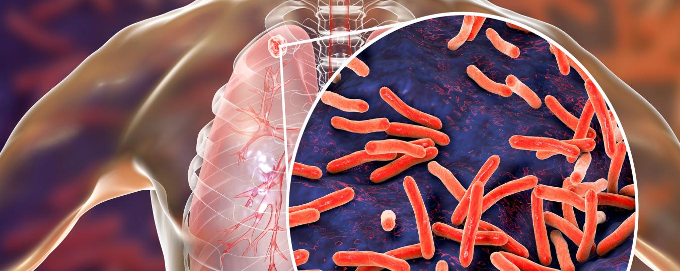 An illustration of tuberculosis in the lungs