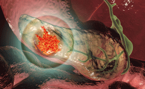 An illustration of pancreatic cancer