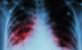 A photo of a chest xray